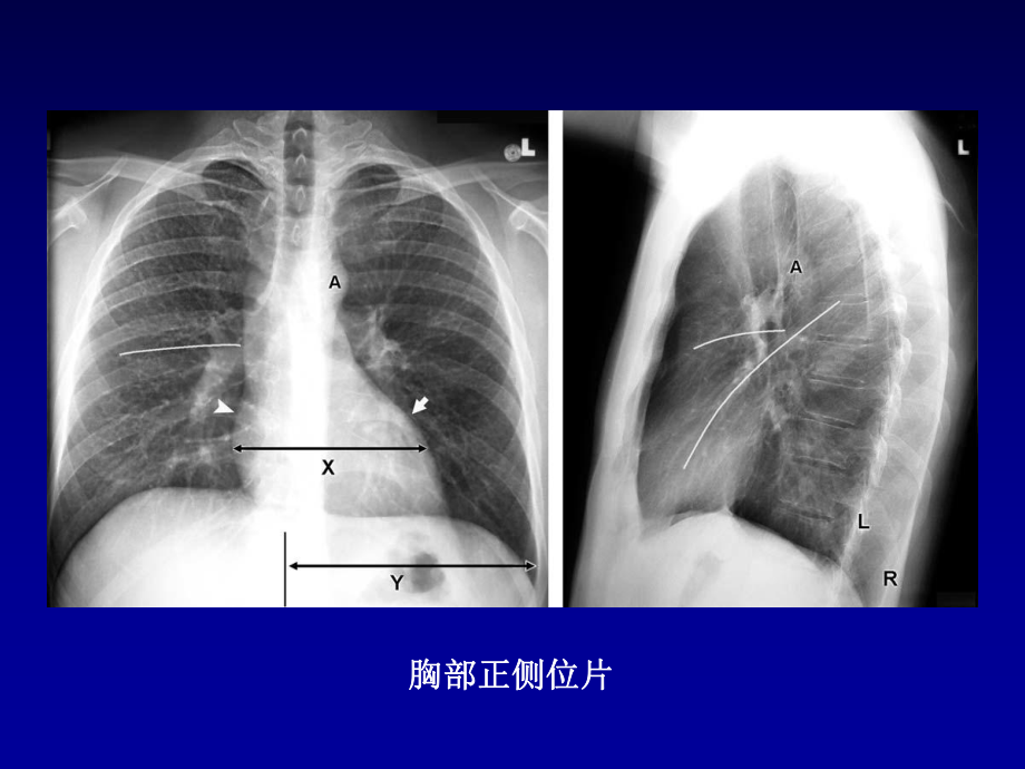 呼吸系统疾病的影像学诊断基础.ppt_第3页