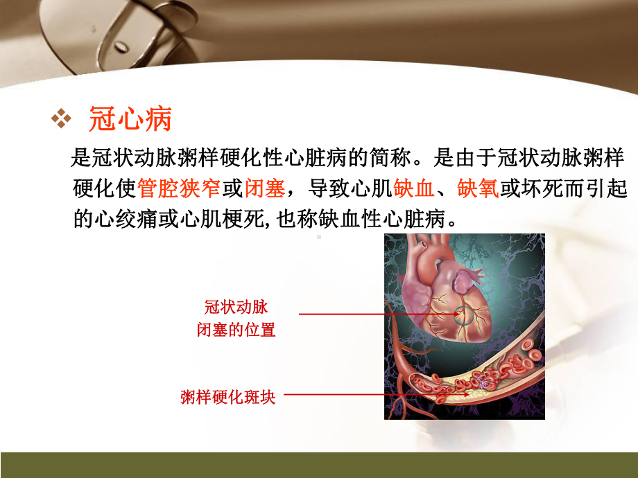 心肌梗死健康宣教PPT课件.pptx_第2页