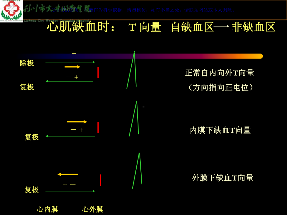 心肌缺血和心肌梗死的心电图改变课件.ppt_第2页