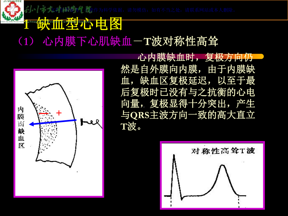 心肌缺血和心肌梗死的心电图改变课件.ppt_第3页