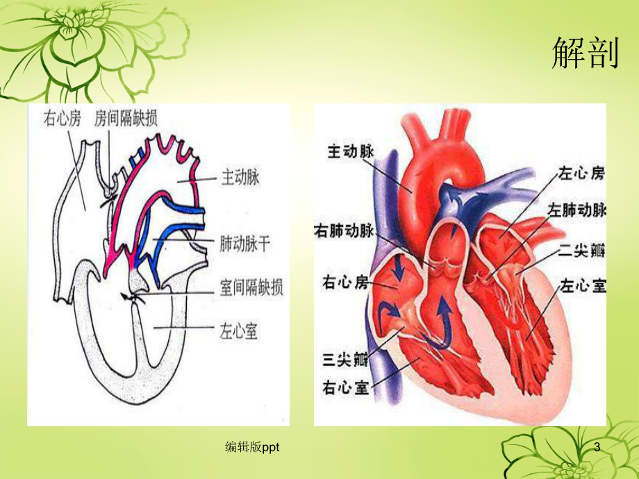 房间隔缺损护理查房ppt课件.ppt_第3页