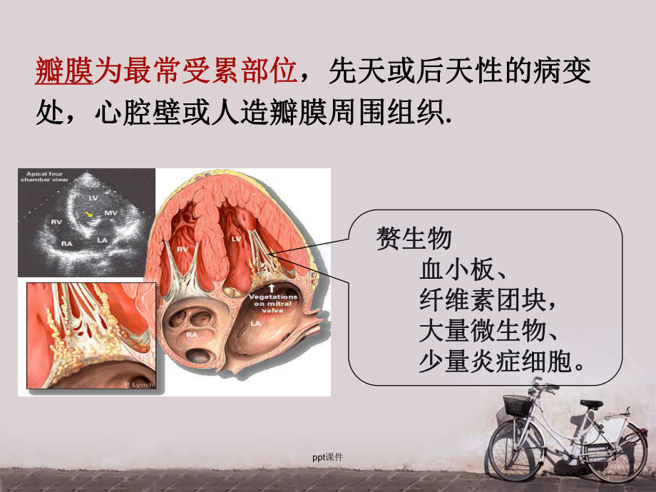 感染性心内膜炎的护理-ppt课件.ppt_第3页