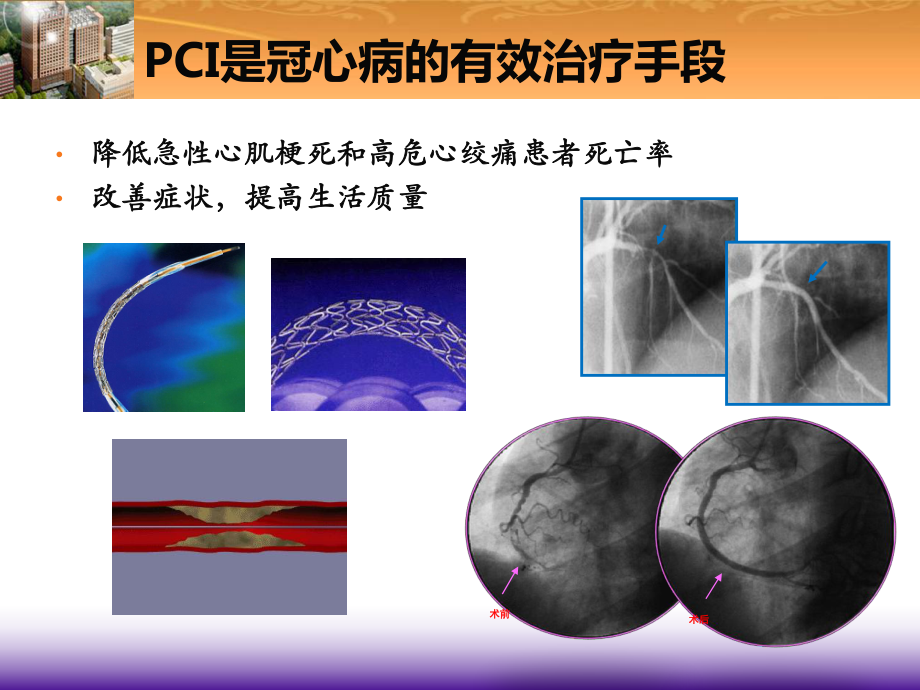 PCI术后心脏康复共识主题讲座课件(共33张).ppt_第3页