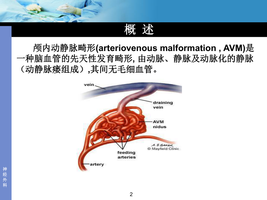 动静脉畸形ppt课件.ppt_第2页