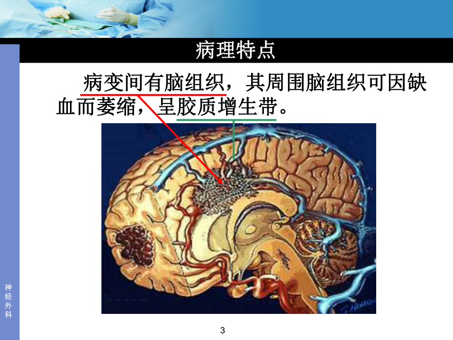 动静脉畸形ppt课件.ppt_第3页