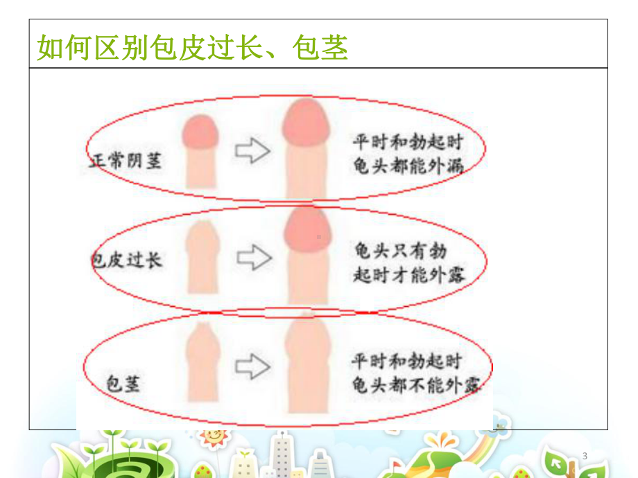 包茎、包皮过长的护理PPT课件.ppt_第3页