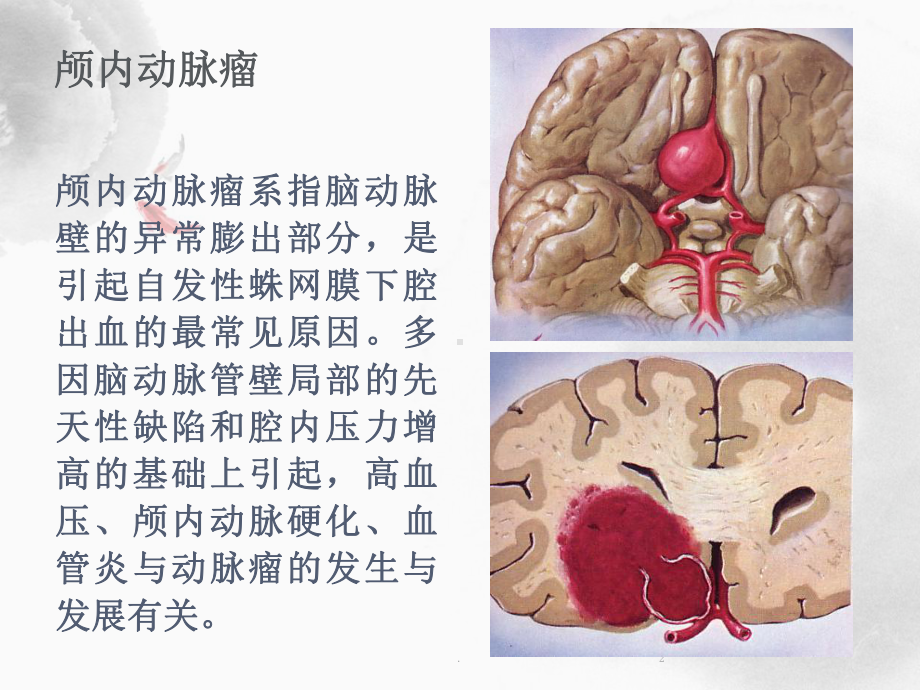 动脉瘤病人护理查房ppt课件.ppt_第2页