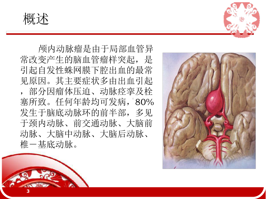 动脉瘤ppt课件.ppt_第3页