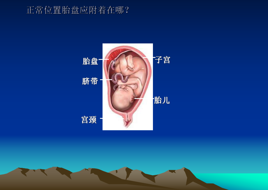 前置胎盘教学查房课件.ppt_第3页