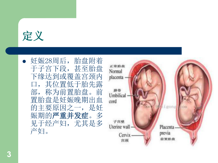 前置胎盘PPT课件.ppt_第3页