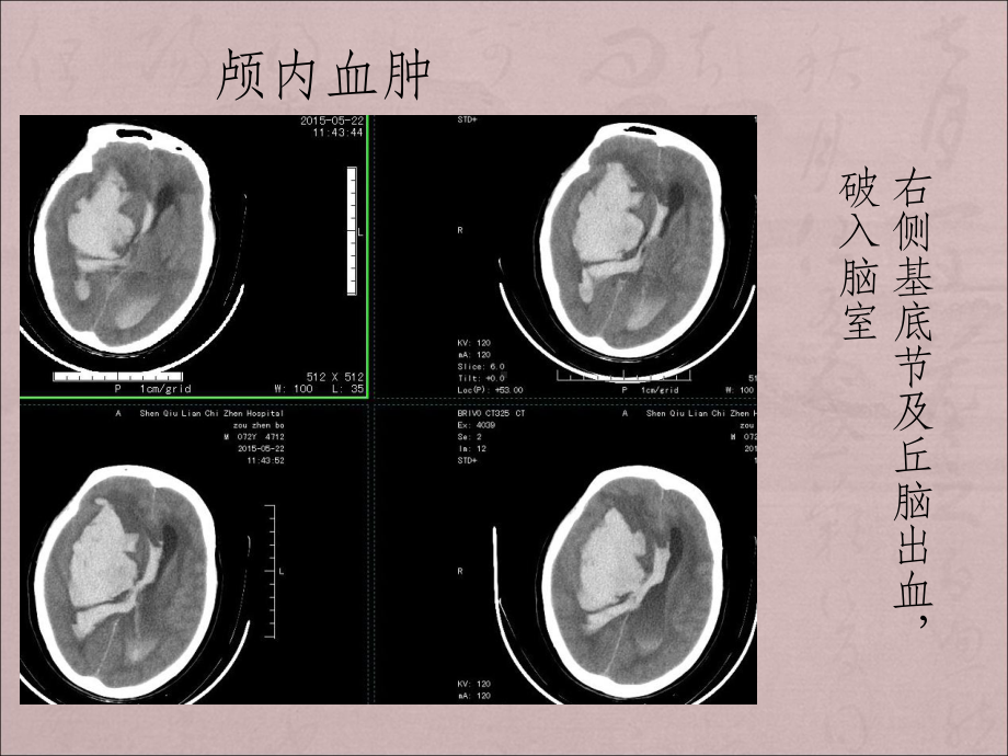 危急值放射科ppt课件.ppt_第3页