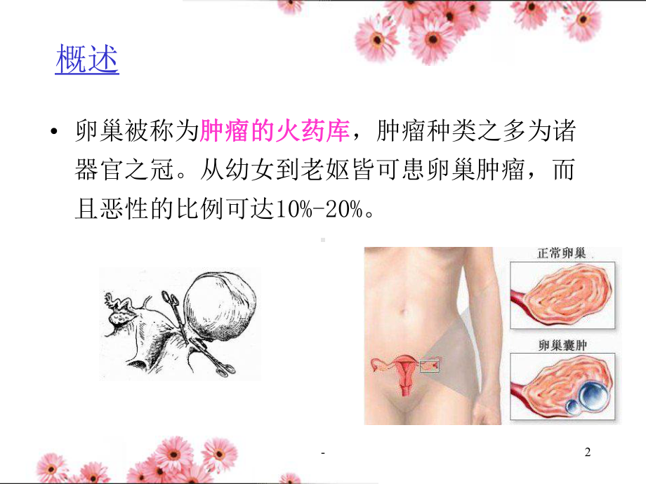 卵巢囊肿PPT课件.ppt_第2页