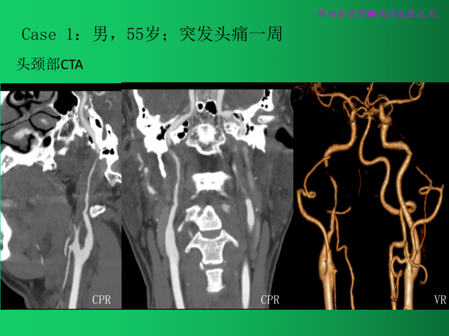 头颈部动脉管壁高分辨MR病例分享课件.pptx_第3页