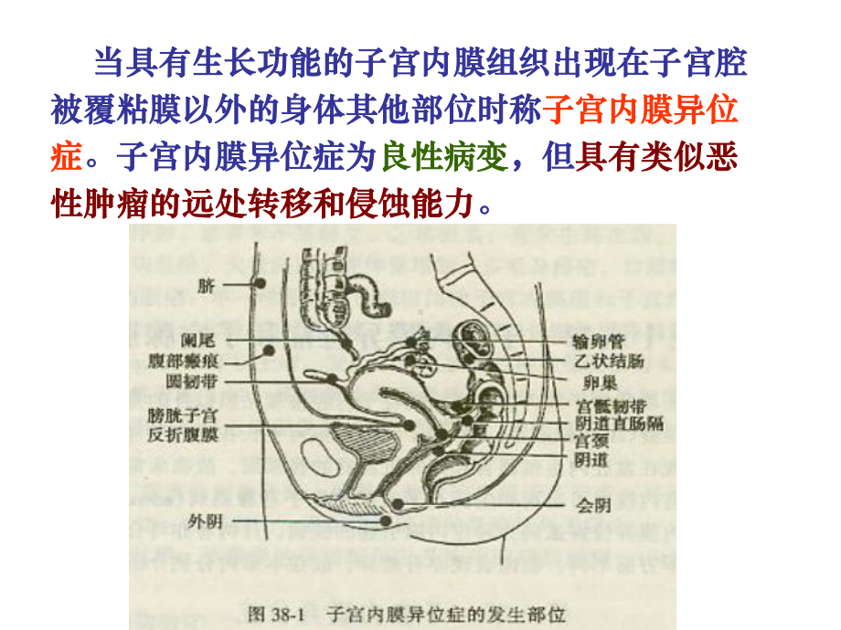 子宫内膜异位症-(2)课件.ppt_第3页