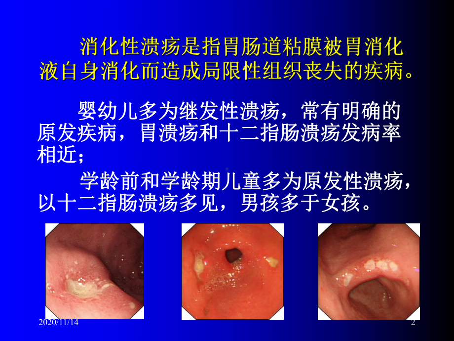 小儿消化性溃疡诊治课件.ppt_第2页