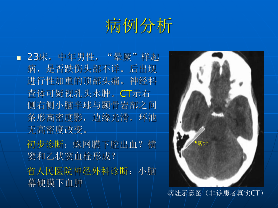 小脑幕硬膜下血肿PPT课件.ppt_第2页