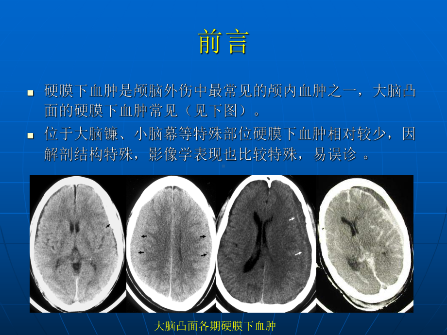 小脑幕硬膜下血肿PPT课件.ppt_第3页