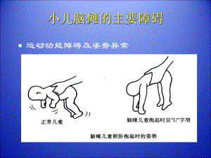 小儿脑瘫康复PPT课件共74页文档.ppt