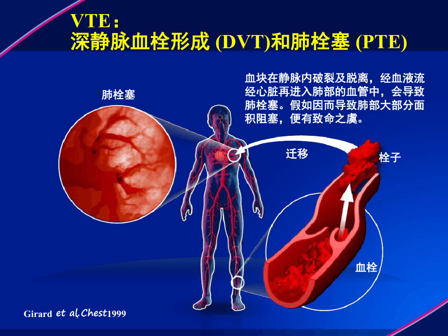 完整版深静脉血栓防治解读课件.ppt_第3页