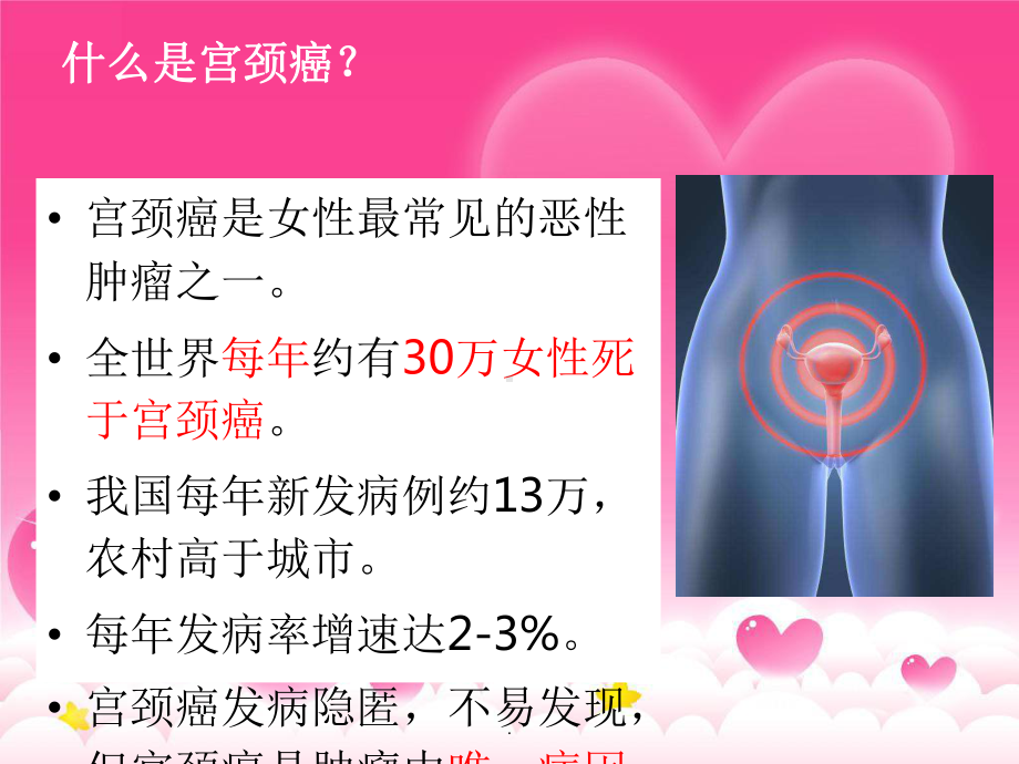 宫颈癌筛查健康宣讲课件.ppt_第2页