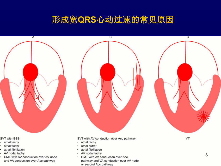 宽qrs心动过速的鉴别诊断-单兆亮PPT课件.ppt_第3页