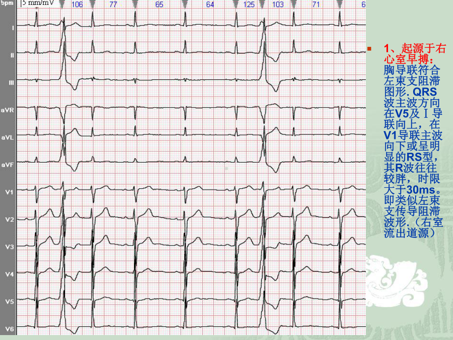 室性早搏定位诊断-2-精品课件.ppt_第2页