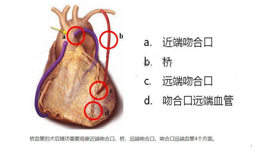 桥血管造影PPT课件.ppt（16页）_第2页