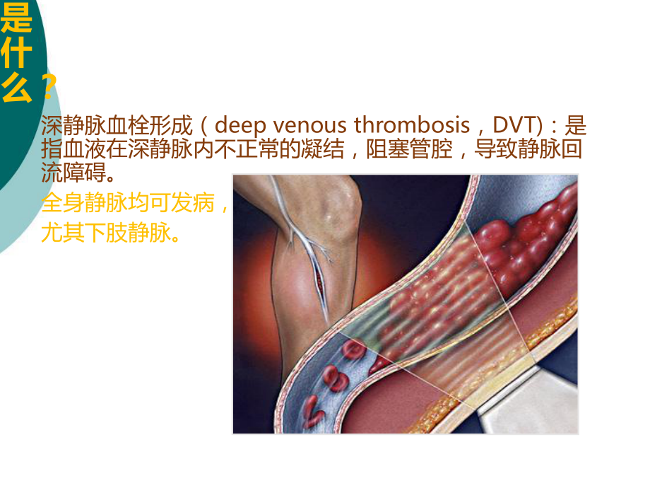 深静脉血栓健康宣教课件.ppt（15页）_第3页