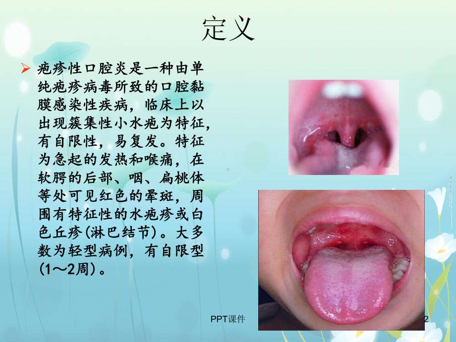 疱疹性咽峡炎-ppt课件.ppt_第2页