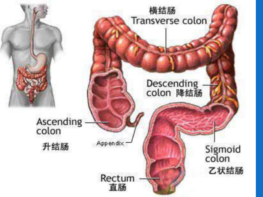 直结肠癌护理课件.ppt_第2页
