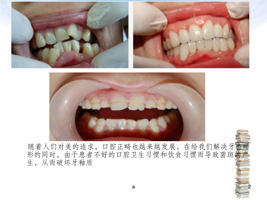 正畸治疗中的口腔健康教育和卫生保健课件.ppt（24页）_第2页