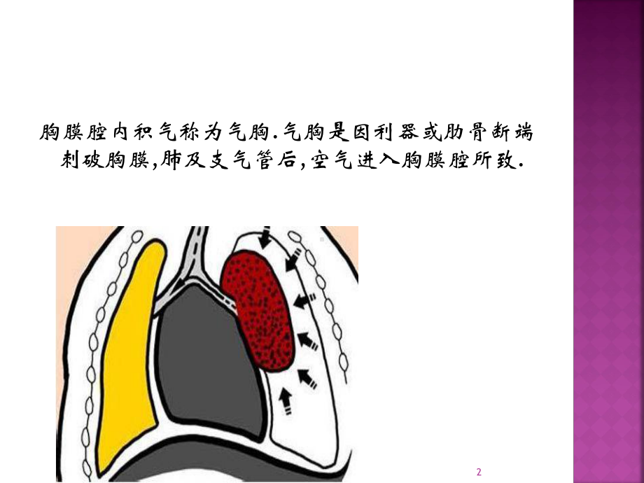 气胸的观察要点和护理PPT课件.ppt（20页）_第2页