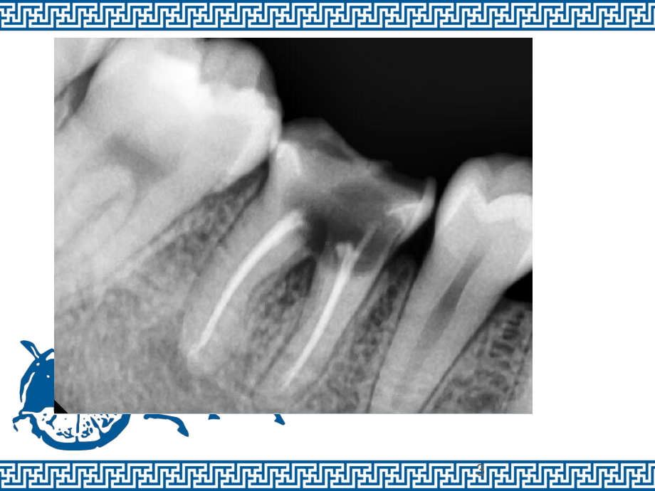 残冠修复病例-ppt课件.ppt（16页）_第3页