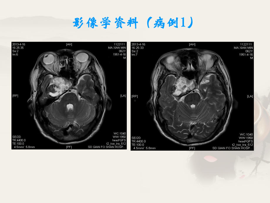 病例讨论-ppt课件.ppt_第3页