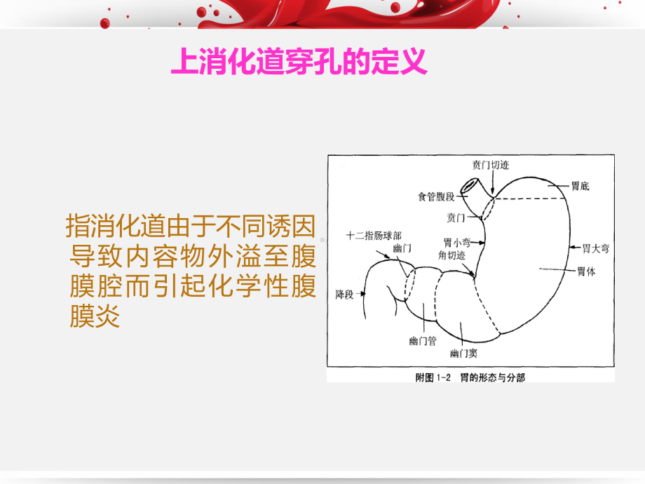 消化道穿孔的护理查房-ppt课件.ppt（21页）_第3页