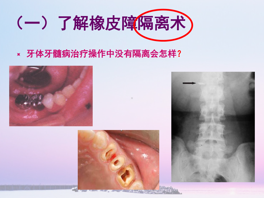 橡皮障PPT课件.ppt（34页）_第3页