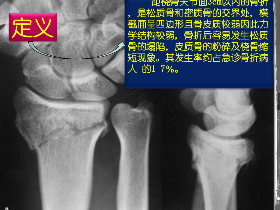 桡骨远端骨折PPT课件.ppt（33页）_第2页