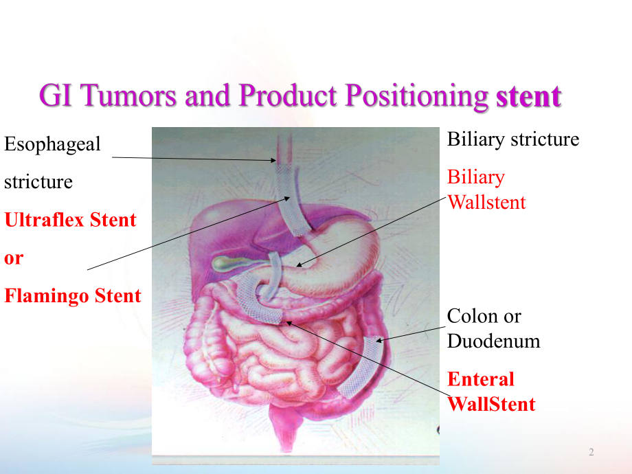 消化道支架的临床应用ppt课件.ppt（92页）_第2页