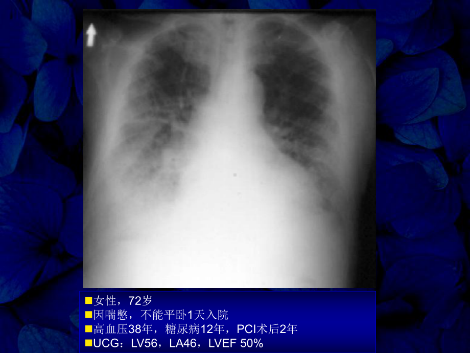 正常射血分数正常心力衰竭的诊断和治疗进展课件.ppt（117页）_第2页