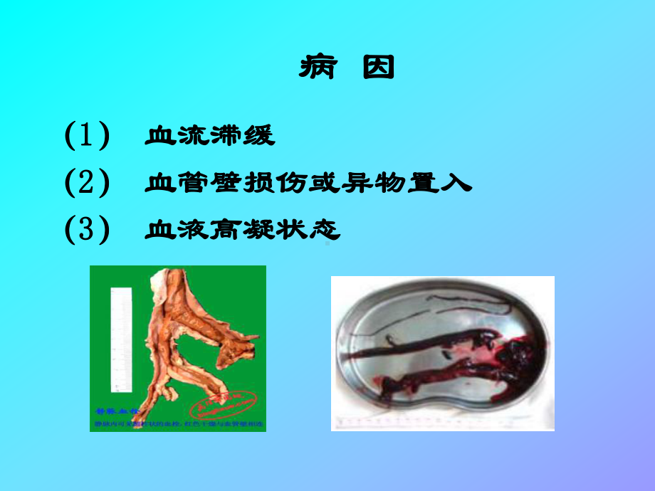 深静脉血栓的护理课件.ppt（31页）_第3页