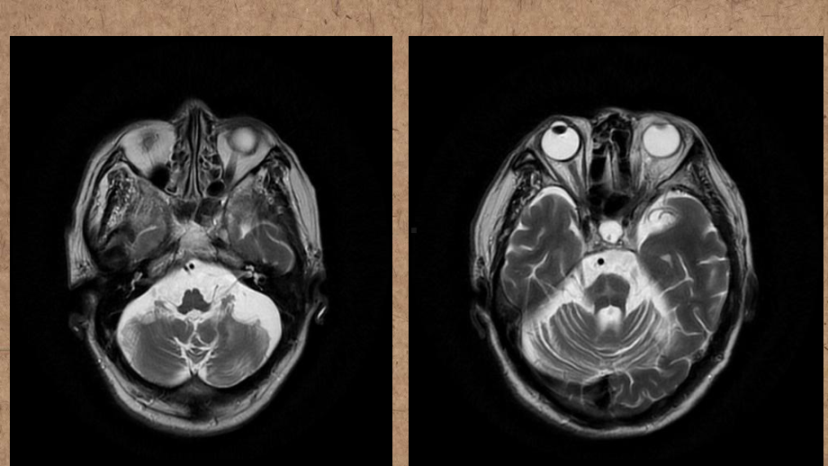 橄榄桥脑小脑萎缩的影像学诊断-ppt课件.ppt（25页）_第2页