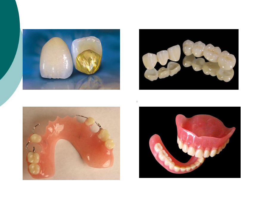 种植义齿概述课件.ppt_第3页