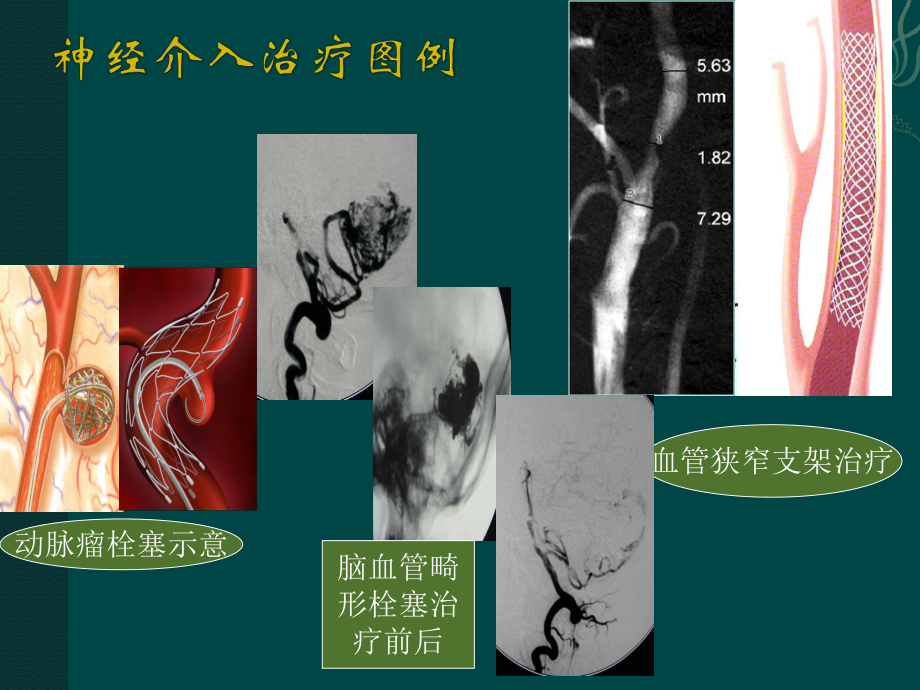 神经外科宣传栏PPT课件.ppt_第2页