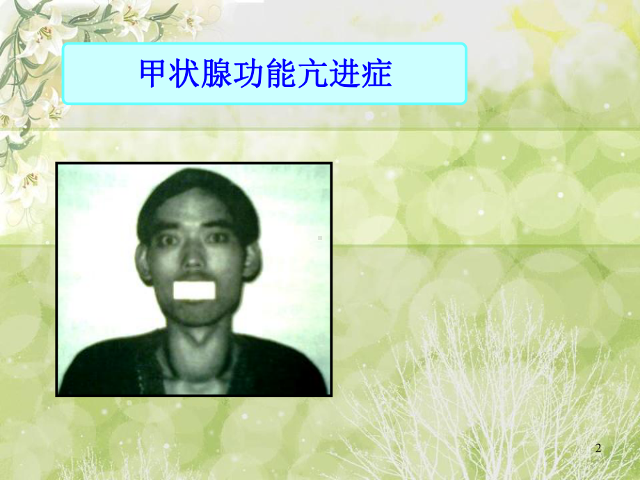 护理查房甲状腺疾病护理ppt课件.ppt_第2页