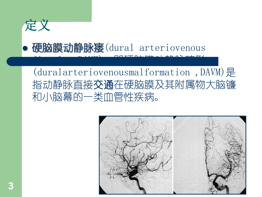 硬脑膜动静脉瘘查房-ppt课件.ppt_第3页