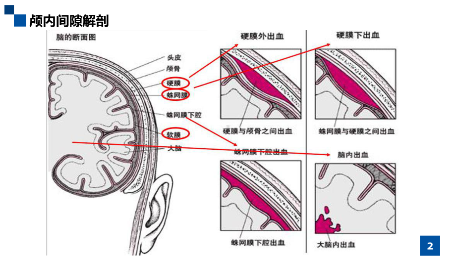 神经外科常见引流管介绍及护理PPT课件.ppt_第2页