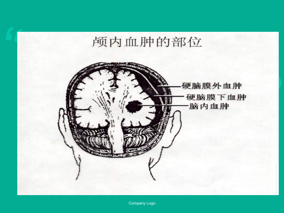 硬膜外血肿PPT课件.ppt_第2页