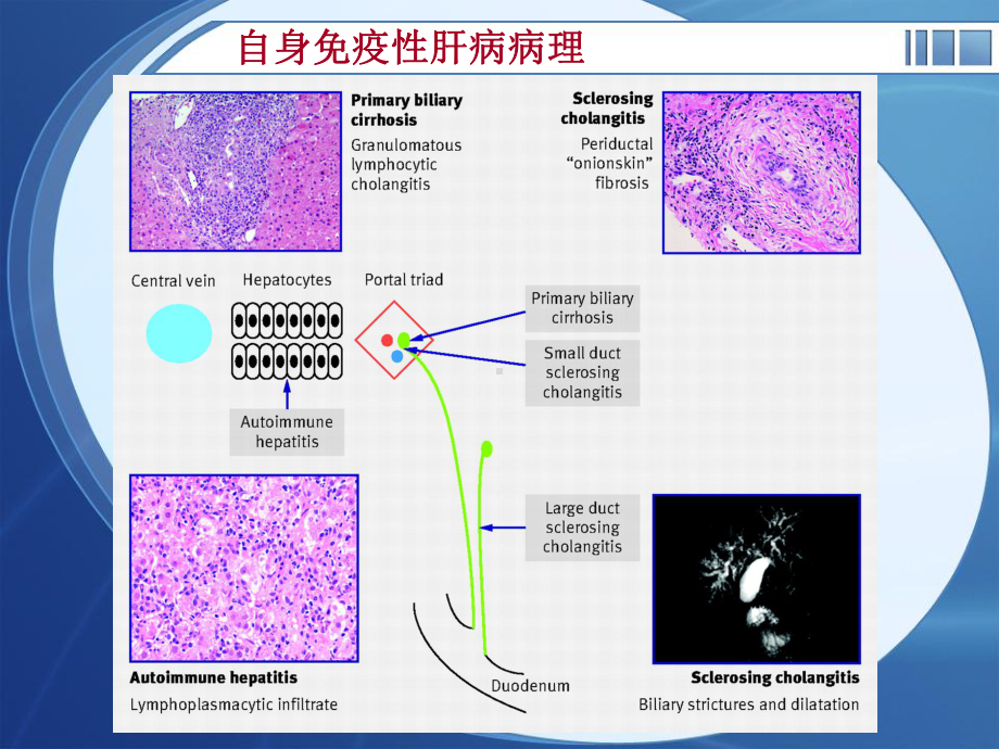 自身免疫性肝病PPT课件.ppt_第3页