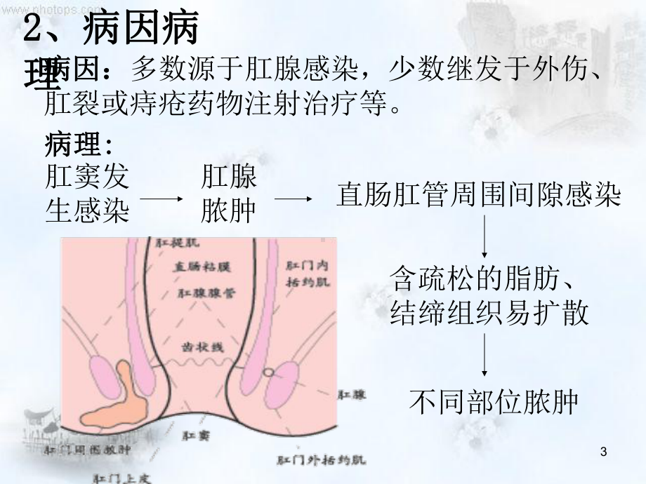 肛周脓肿护理查房PPT幻灯片课件.ppt_第3页