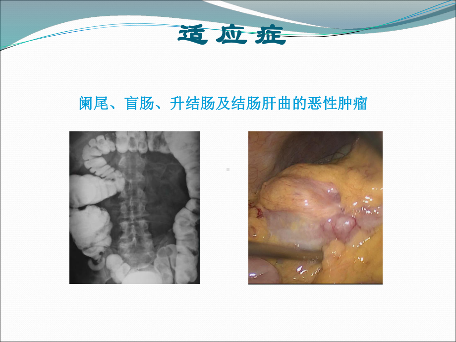 腹腔镜右半结肠切除术ppt演示课件.ppt_第3页